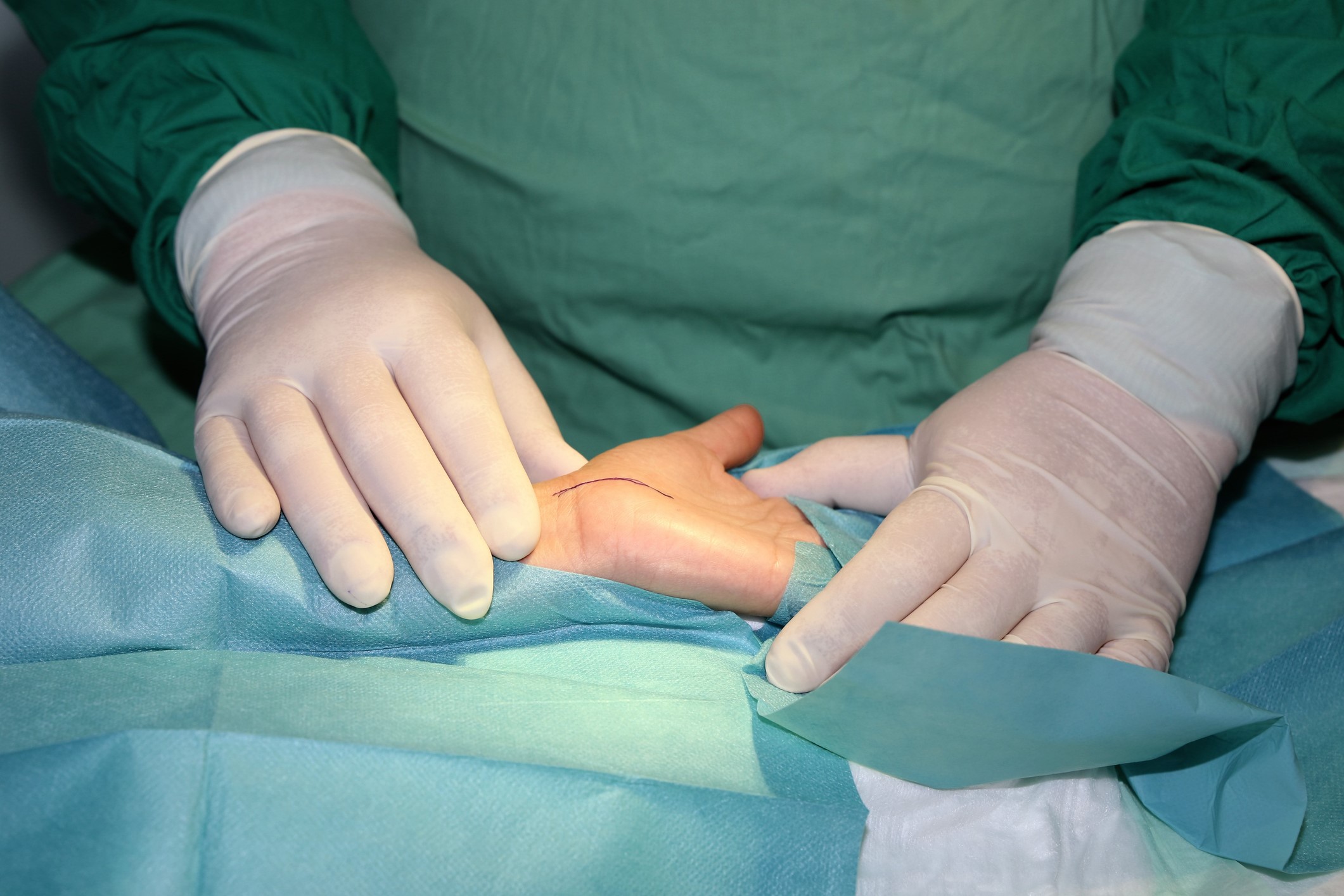 Hand Transplant Surgery Photo